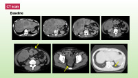 CT scan